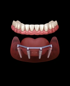 All-on-4 and Full Arch Implant Treatment