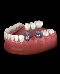 Implant-Supported Bridges