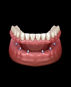 Implant Supported Dentures