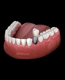 Single Tooth Implants