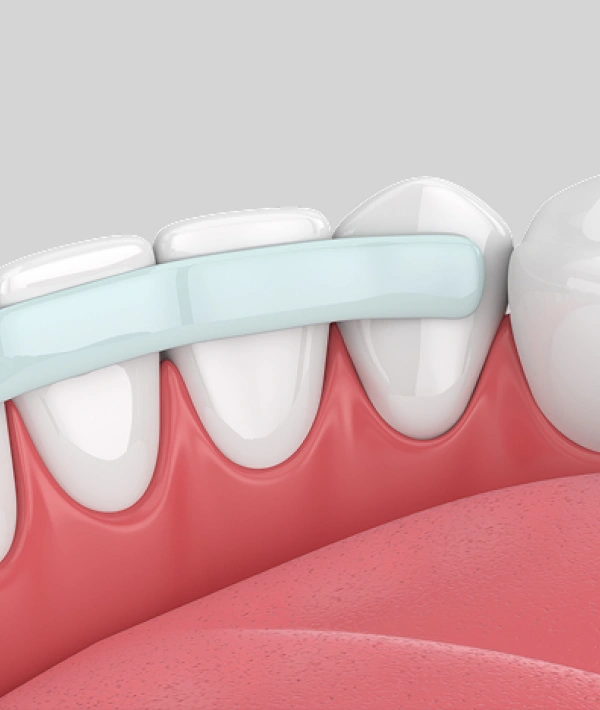 Dental bonding treatment illustration