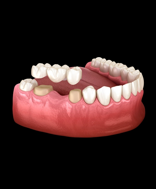 Dental bridge shown on a dental model