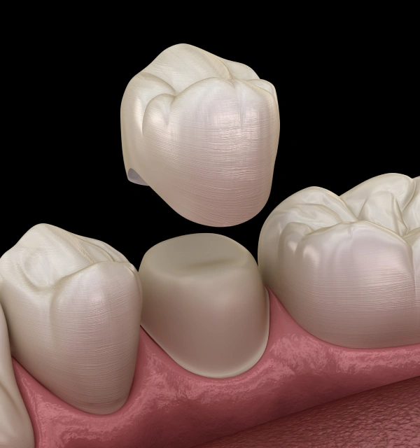 Dental crowns displayed on a tooth model