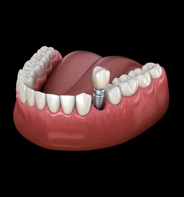 Dental implants shown on a jaw model