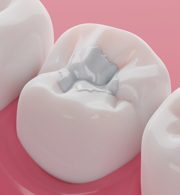 Tooth with a tooth-colored filling